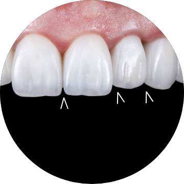 Progression of  Maxillary Incisal Embrasures （上顎の歯の角度について）