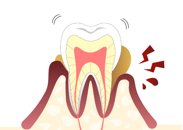 Dental Exam 02 歯周病のチェック