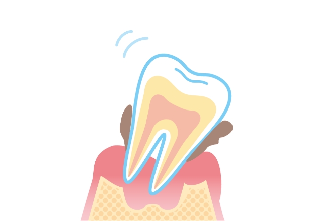 5．重度の歯周病