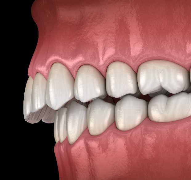 １．歯並び・骨格の問題