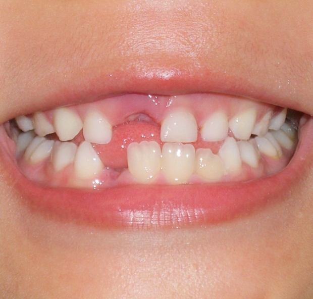 先天性欠損歯に対する治療（歯が足りない場合）