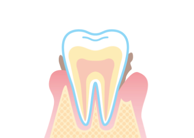 中度の歯周病